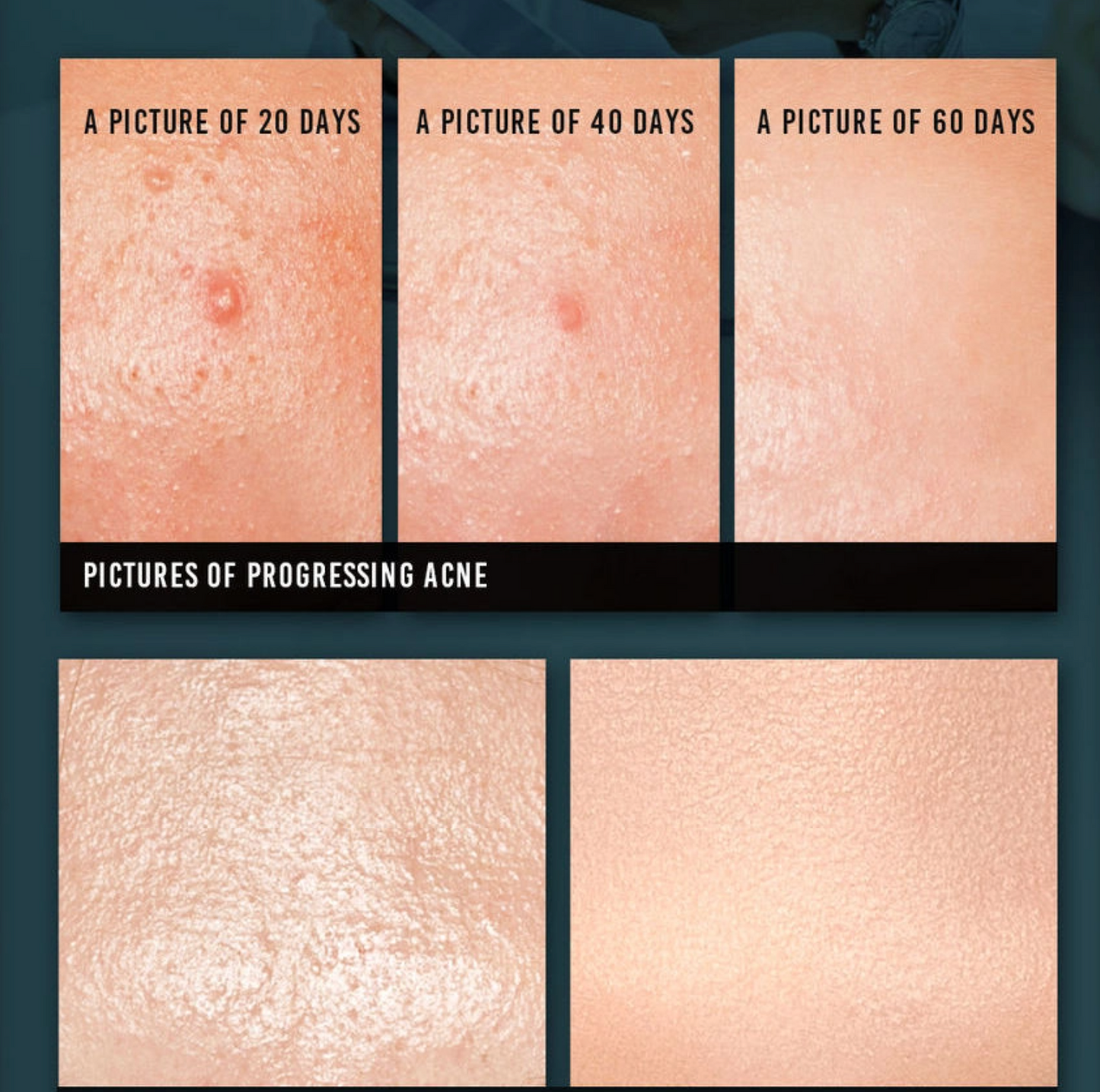 PyunkangYul - Acne Cream 50ml